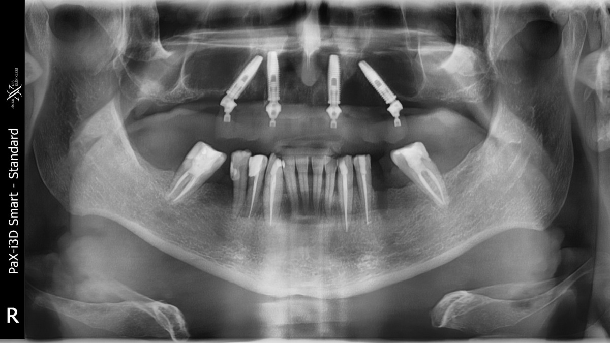 What are the Differences Between Dental Tomography and Panoramic X-ray?