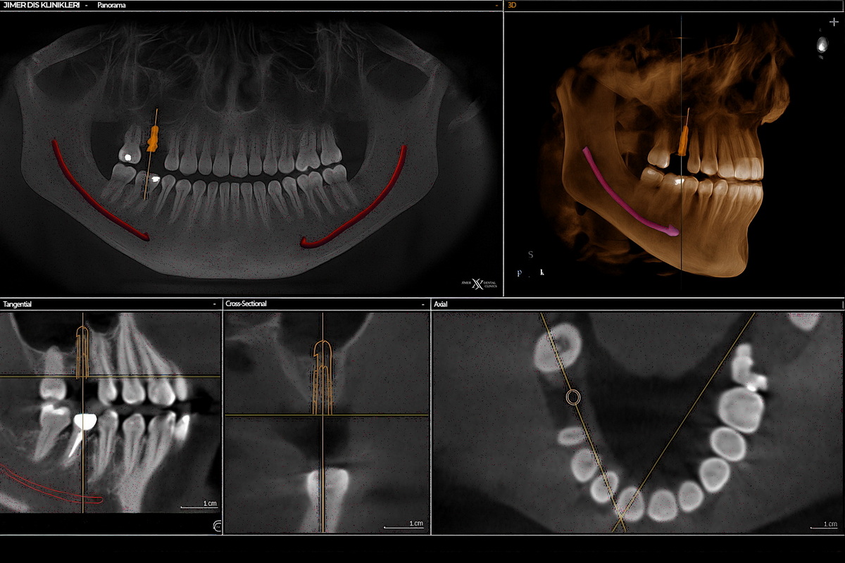 Uses of Dental Tomography