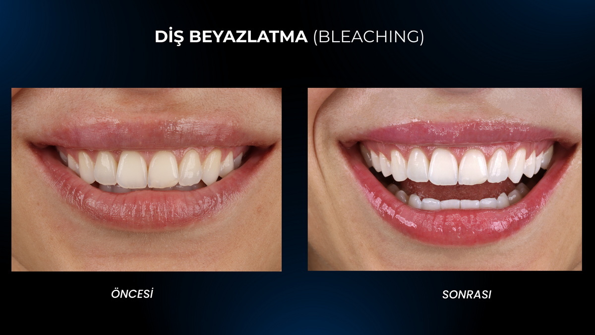 Bursa Teeth Whitening (Dental Bleaching)