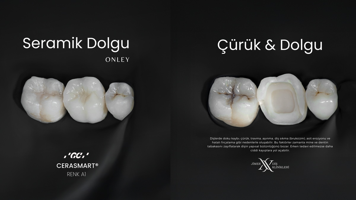Glass-Ceramic Crowns