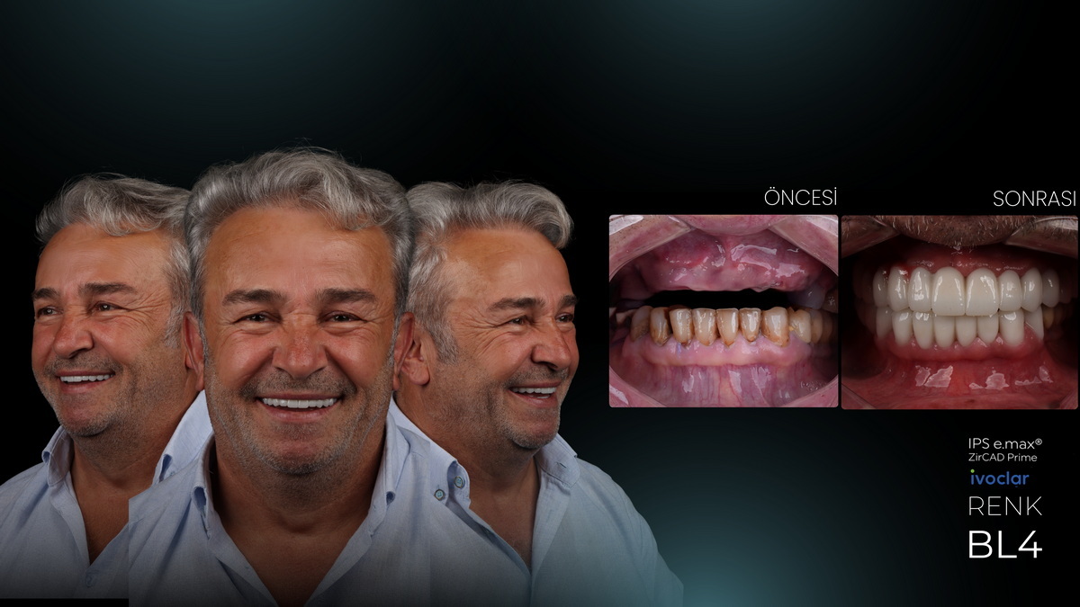 Personalized Smile Aesthetics and Increased Self-Confidence