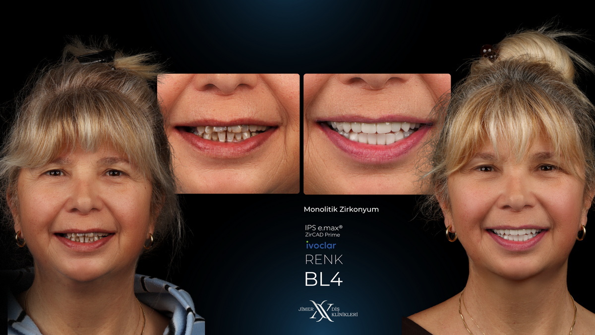 Who is Aesthetic Dentistry Suitable For?