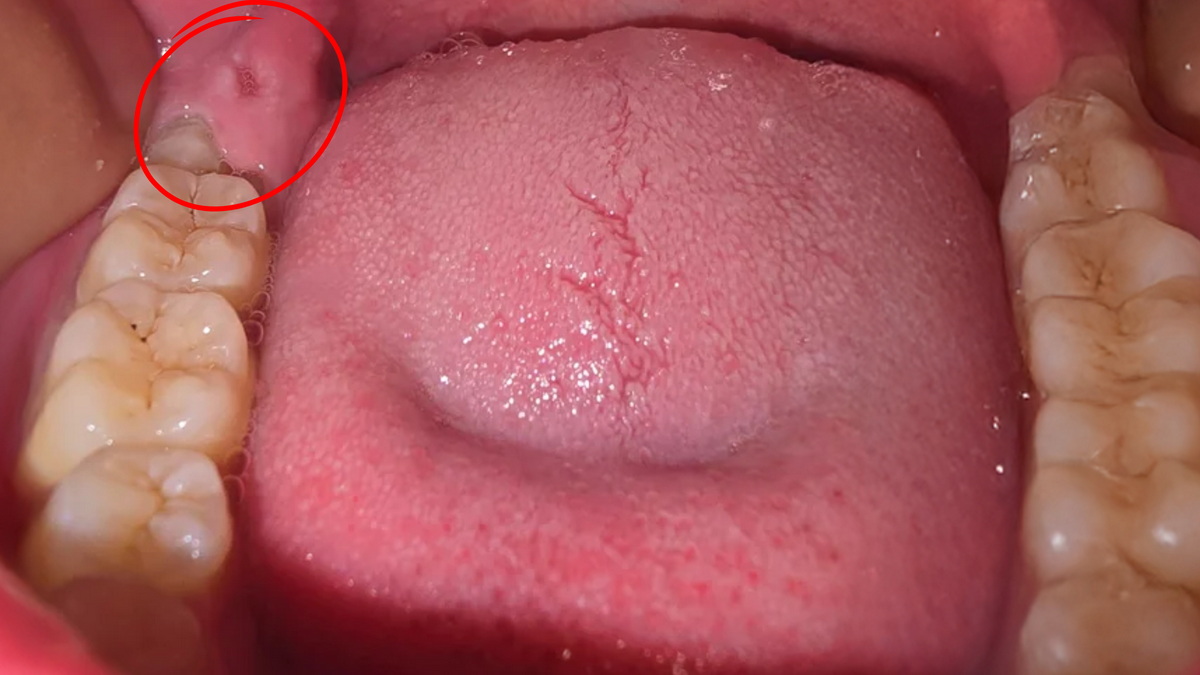 What Happens If a Partially Impacted Wisdom Tooth Is Not Extracted?