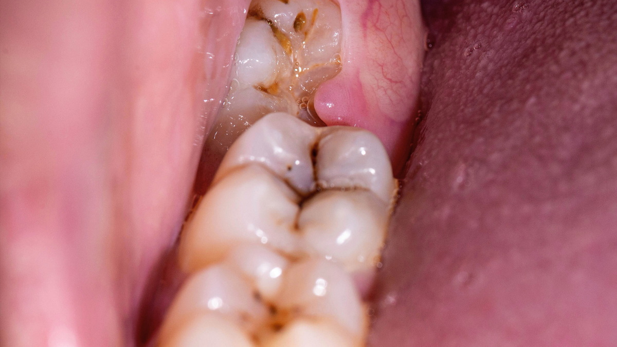 Wisdom Teeth and Cyst Formation