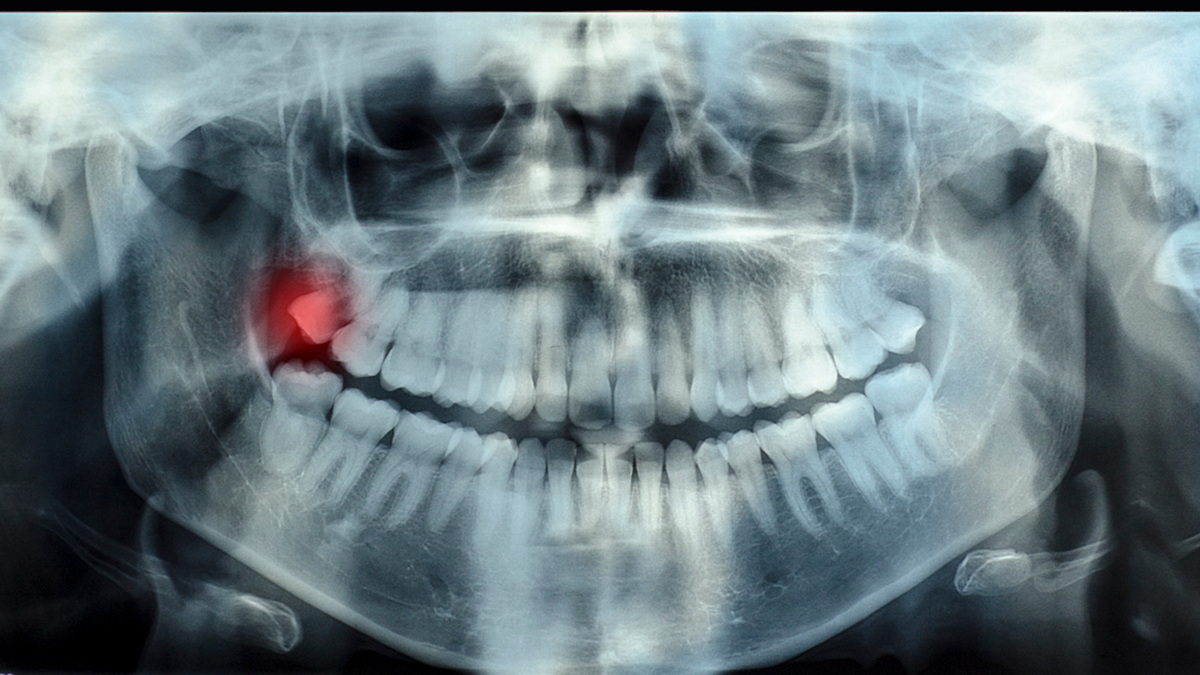 Why Do Wisdom Teeth Cause Pain?