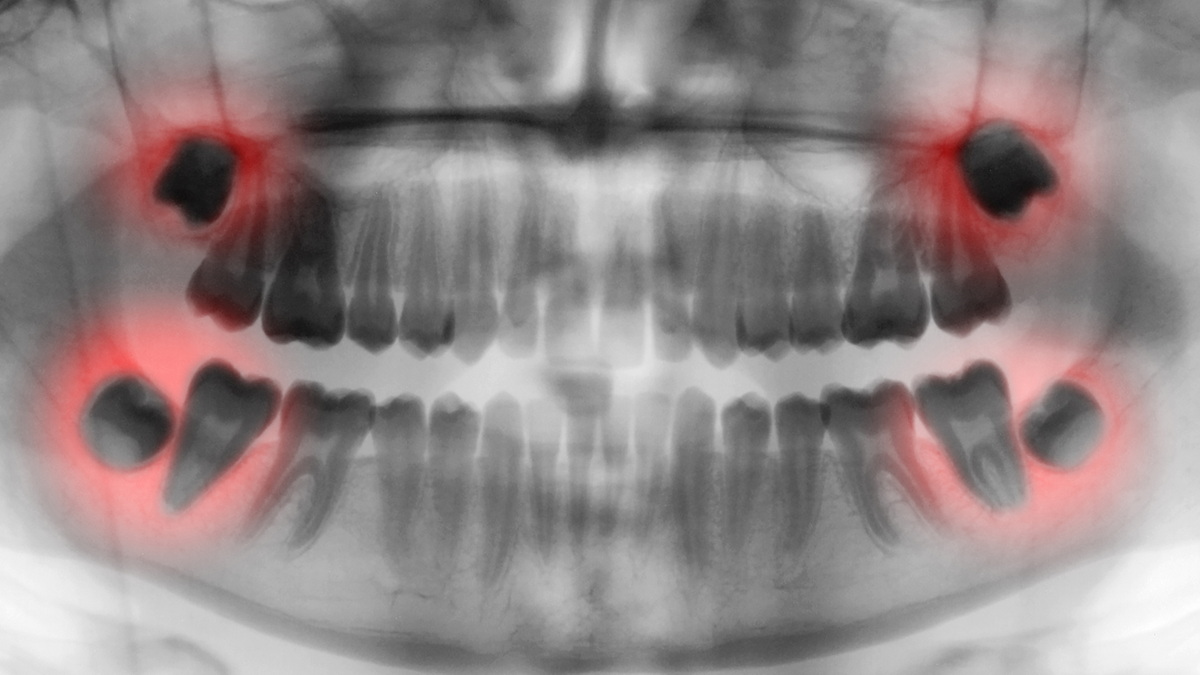 What are Wisdom Teeth? What are They Used For?