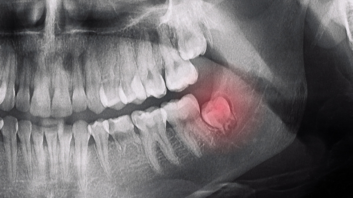 How to Identify Impacted Wisdom Teeth Problems?